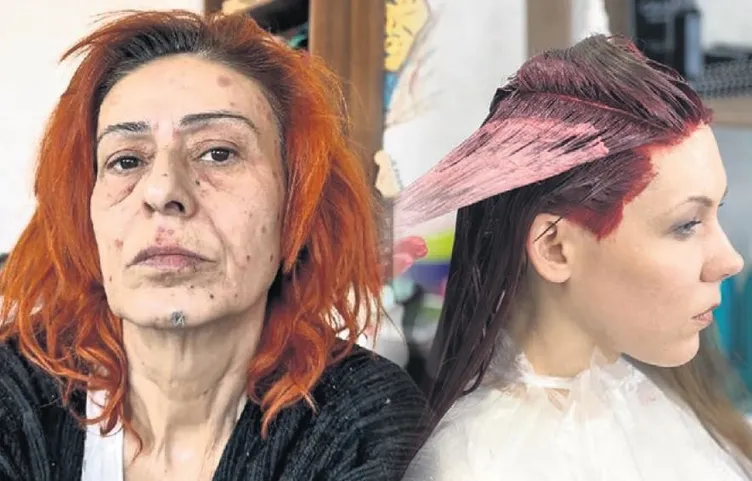 Yıldız Tilbe saç boyasıyla yüzünü yakmıştı! Uzmanlardan uyarı geldi: Ölümcül tehlike