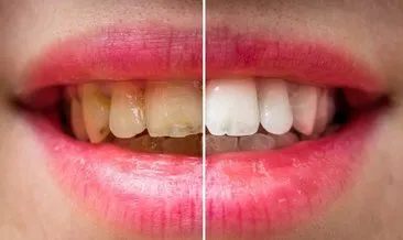 Bu doğal yöntem sayesinde dişleriniz bembeyaz olacak!