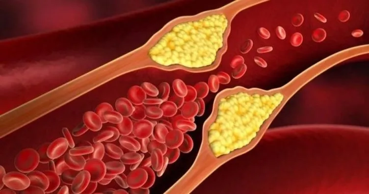 Kolesterol nedir? Kolesterol neden yüksek çıkar, yüksek kolesterole neden olan durumlar nelerdir?