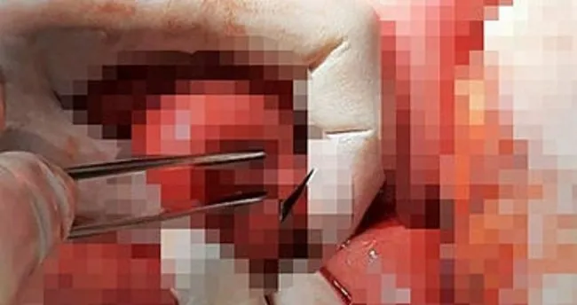 Ankara'da şoke eden olay! Karın ağrısı şikayetiyle gittiği hastanede vücudundan 2 neşter çıkarıldı