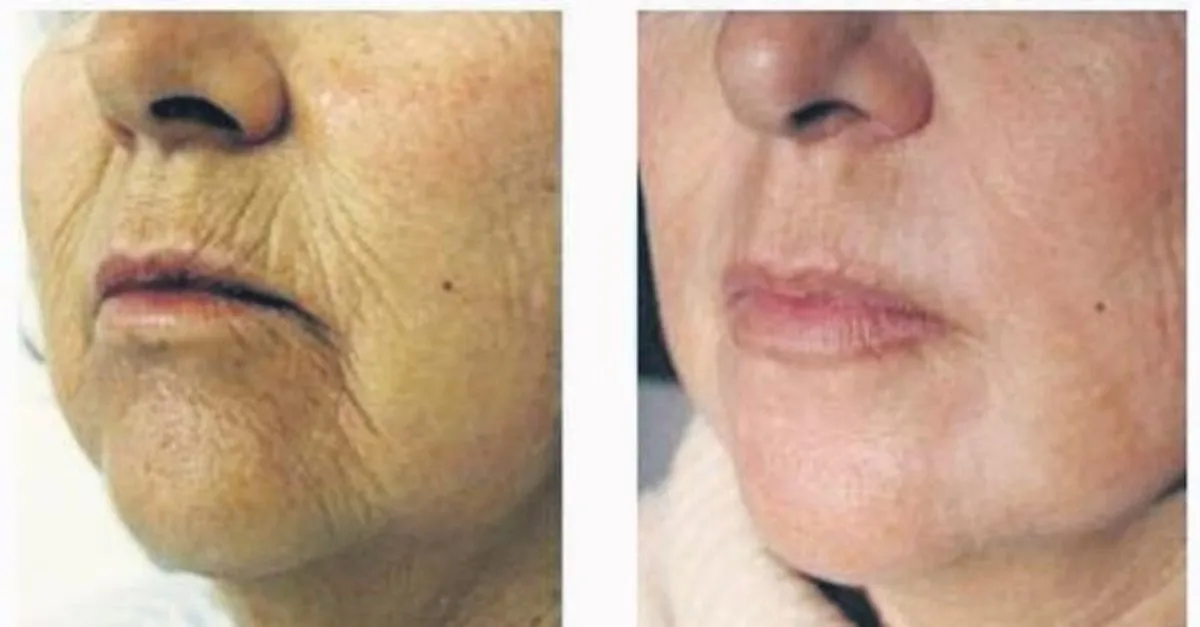 Dudak Ve Dil Bagi Problemlerine Ameliyatsiz Cozum Konya Bolge Haberleri