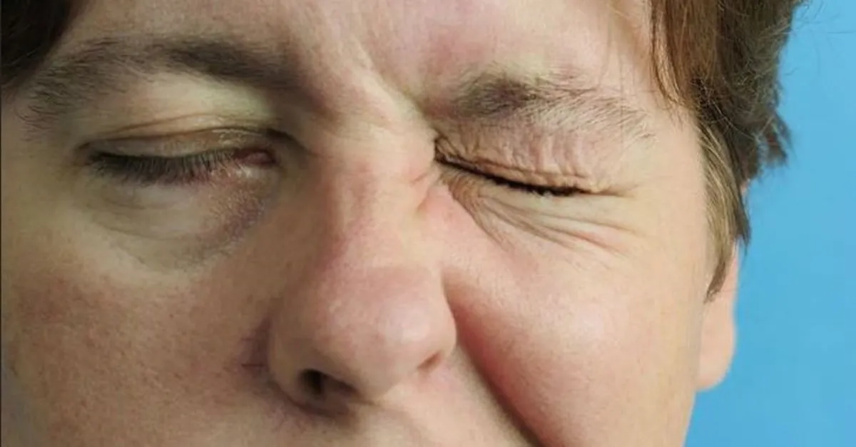 Yuz Felci Neden Olur Yuz Felci Tedavisi Nasil Yapilir Saglik Haberleri