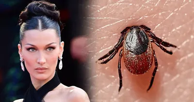 Lyme hastalığı nedir, tedavisi var mı? Bella Hadid’in hastalığı LYM Lyme belirtileri nelerdir, ölümcül müdür?