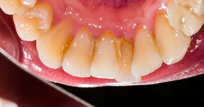 Diş taşları nasıl geçer? İşte diş taşlarından kurtulmanın en kolay yolu