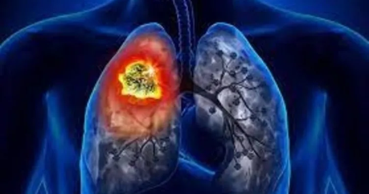 Akciğer kanseri ölüm sıralamasında ilk sırada