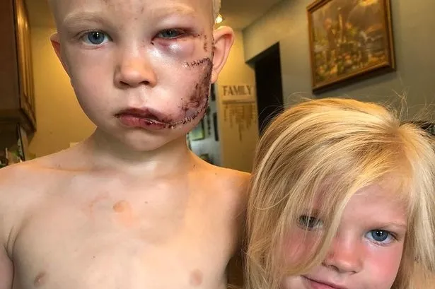 Son dakika haberi: Dünya onu konuşuyor! 4 yaşındaki kardeşini korumak için araya girdi: 90 dikiş var...