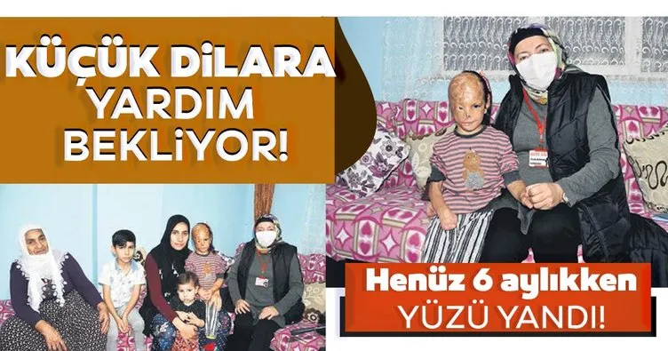 Yüzü yanan Dilara destek bekliyor