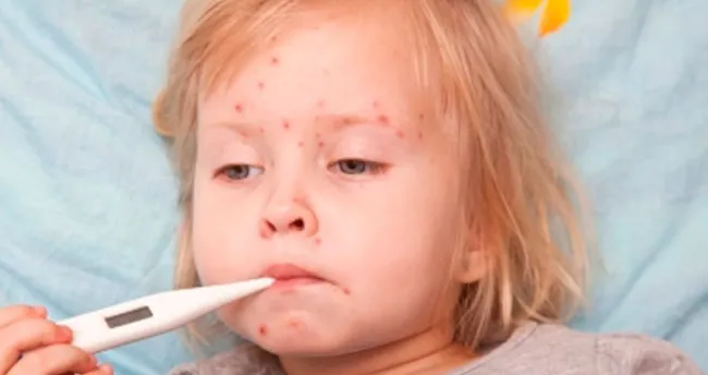 Çiçek hastalığı nedir, tedavisi nasıl olur?