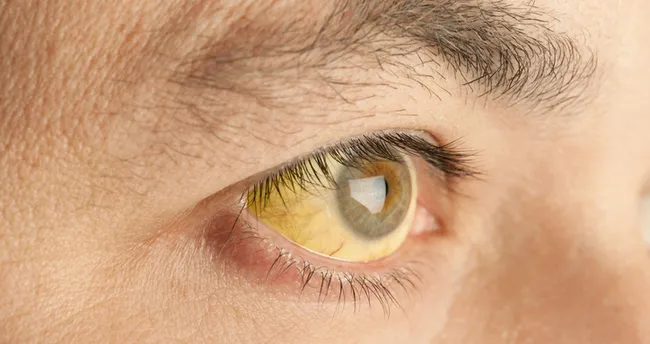 Bilirubin Nedir? Bilirubin Yüksekliği ve Düşüklüğü Ne Anlama Gelir, Normal Değerleri ve Referans Aralığı Nedir?