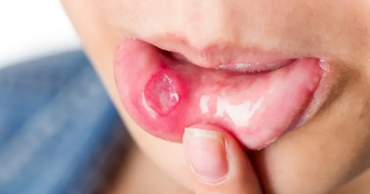 Çağımızın vebası Candida enfeksiyonu!