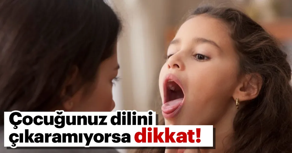 Çocuğunuz dilini çıkaramıyorsa dikkat! Sağlık Haberleri