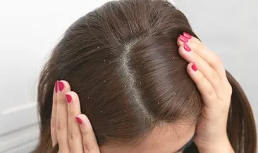 Saçta kabuklu kepek neden olur, bitkisel ve evde doğal çözüm yöntemleri ile nasıl geçer? Saçtaki kepek nasıl temizlenir?