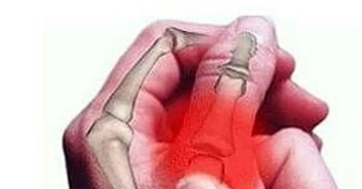 Romatizma Nedir Neden Olur Romatizma Belirtileri Nelerdir Saglik Haberleri