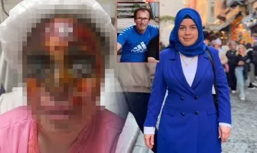 60 yaşındaki takıntılı aşığı Şaban Kement kabusu yaşattı: Yüzüne kezzap atılan Şengül Selük kör kaldı! #istanbul