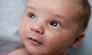 bebeklerde sivilce icin ne zaman doktora gidilmelidir saglik haberleri