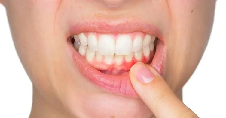 Diş İltihabı Vücuda Yayılma Belirtileri Nelerdir? Diş Kökü İltihabı Nerelere Vurur, Vücudu Nasıl Etkiler?