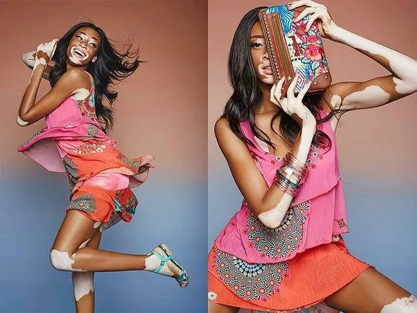 Cilt lekeleriyle ünlü olan model Winnie Harlow, Dubai'de!