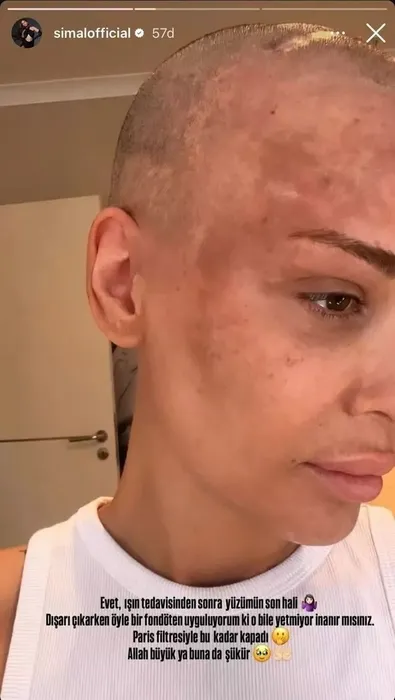 Zor günler geçiren şarkıcı Şimal saçlarını kazıtmıştı! Işın tedavisinden sonra yüzünün son halini paylaştı