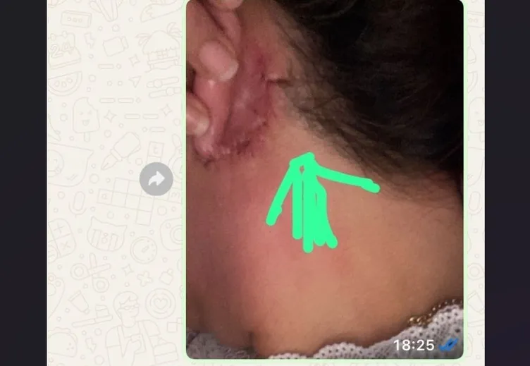 SON DAKİKA | Estetik ameliyatı genç kadının kabusu oldu: Kulağını kesip yüzünü diktiler