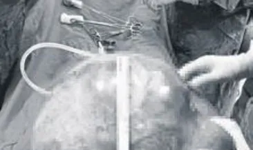 Karnından çıkan dev kitle şaşırttı