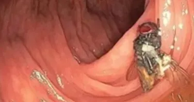 Kanser taramasında şok eden görüntü: Doktorlar cevap veremedi! Bağırsaklarında canlı şekilde geziyordu...