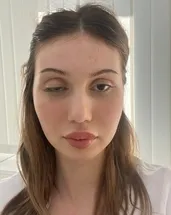 Merdiven altı botoks faciası