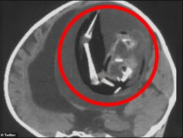 Çin’de akılalmaz olay! İkiz kardeşinin kafatasından çıkarıldı