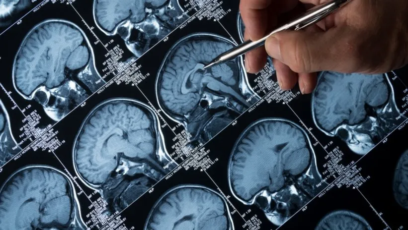 Beyin tümörünün yeni türleri ortaya çıktı! Tedavilerde başarı şansını artabilir...