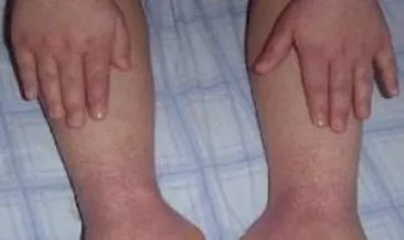 Ruyada Bacak Kesilmesi Gormek Haberleri Son Dakika Ruyada Bacak Kesilmesi Gormek Gelismeleri