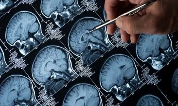 Beyin tümörünün yeni türleri ortaya çıktı! Tedavilerde başarı şansını artabilir...