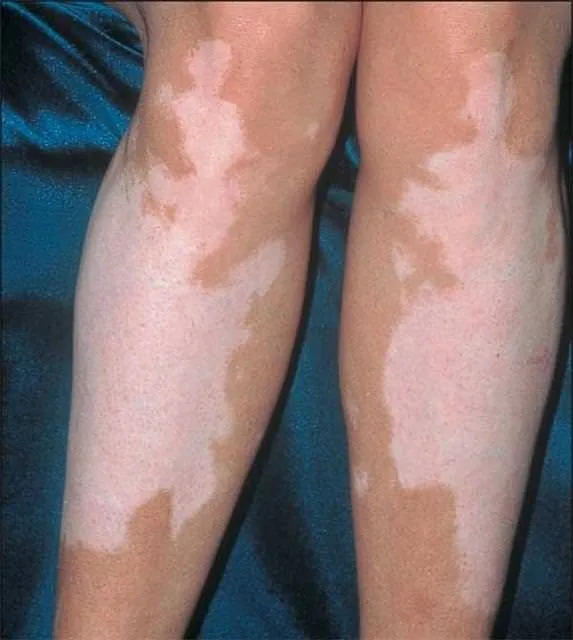 vitiligo sinsi beyazlik galeri yasam