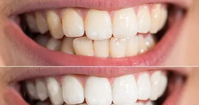 Dişleriniz sararsın istemiyorsanız çözümü çok basit! İşte diş sararmasını önlemenin yolları...
