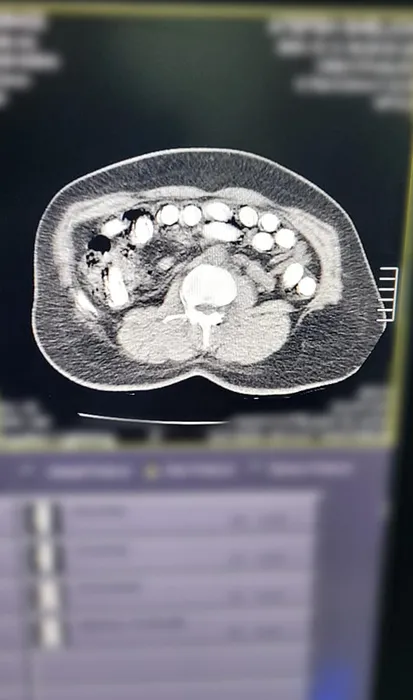 Kayseri’de düzenlenen operasyonda midesinden çıkanlar şoke etti: Tam 1 kilo!