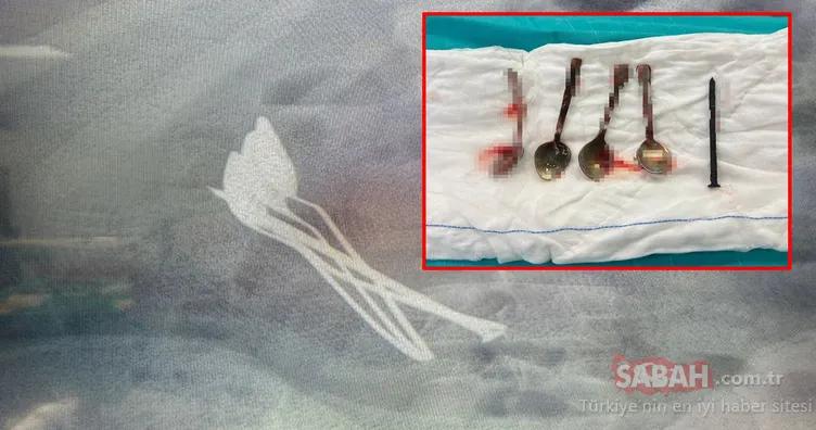 Kayseri’de akılalmaz olay: Doktorlar şaşkına döndü! Hepsi 15 yaşındaki çocuğun midesinden çıktı