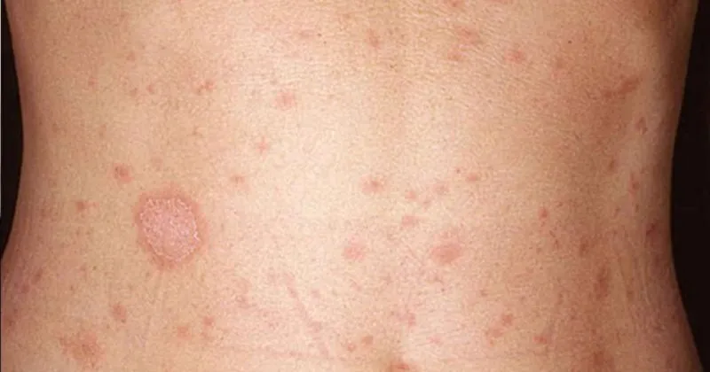 belirtileri nelerdir