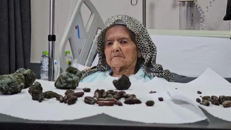 Doktorlar şoke oldu: 92 yaşındaki kadının midesinden ve bağırsaklarından neler çıktı neler!