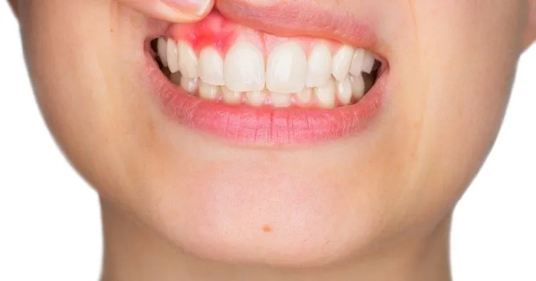Diş uçlarının şeffaflaşması neden olur, doğal ve bitkisel tedavi ile nasıl geçer? Diş uçlarındaki şeffaflığa ne iyi gelir?