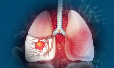 Akciğer kanseri olanların Yüzde 60’ında görülüyor! Tartıda gördüğünüz bu  rakam en büyük sinyali…