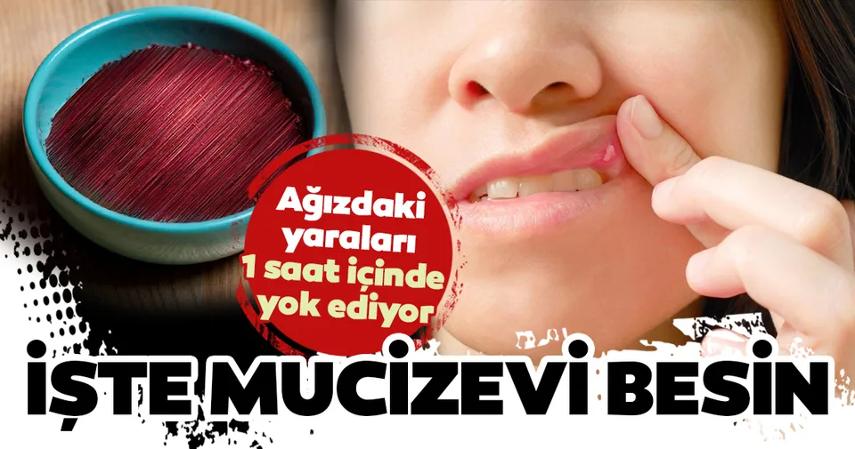 aft yaralarini 1 saat icerisinde yok eden mucizevi besin saglik haberleri aft yaralarini 1 saat icerisinde yok eden mucizevi besin saglik haberleri