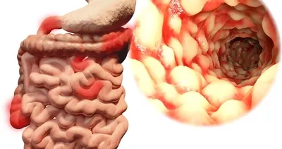 En çok görülen kanser türü bağırsak kanseri korkutuyor! İşte bağırsak kanserinden koruyan besinler ve faydaları!