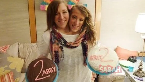 Yaşamaz demişlerdi, 28 yaşına geldiler....Ünlü ikizlerden şaşırtan karar!
