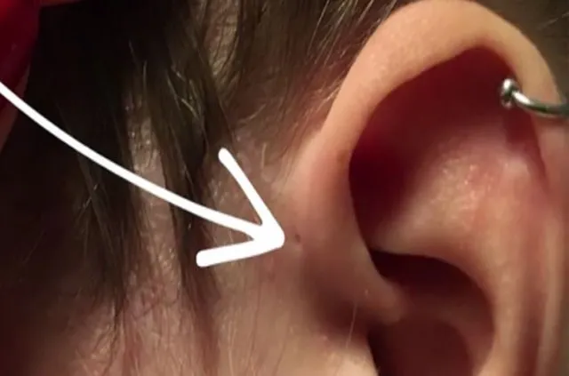 Kulaktaki küçük delikler ne anlama geliyor?