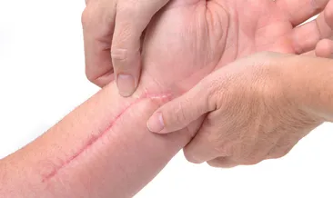 Çinli bilim insanları, yara izlerini yok eden jel geliştirdi