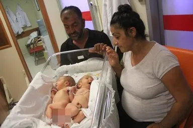 Yapışık ikizler dünyaya geldi