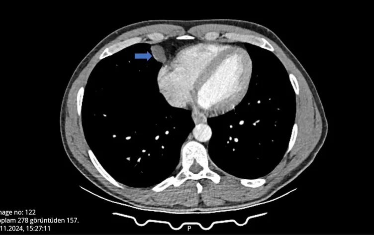 Öksürük ve hapşırık krizine girdi! Hastanedeki sonucu görünce şoke oldu!