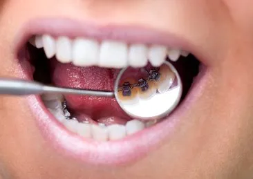 Ortodontik diş tedavisinde yeni yöntem: telsiz ortodonti