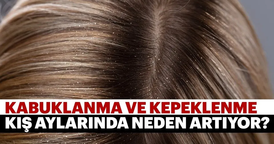 kepeklenme ve kabuklanma neden