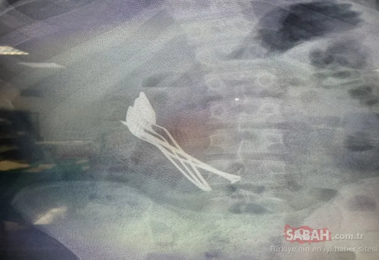 Kayseri’de akılalmaz olay: Doktorlar şaşkına döndü! Hepsi 15 yaşındaki çocuğun midesinden çıktı