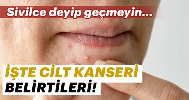 cilt deri kanseri nedir cilt deri