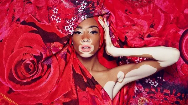Cilt lekeleriyle ünlü olan model Winnie Harlow, Dubai'de!